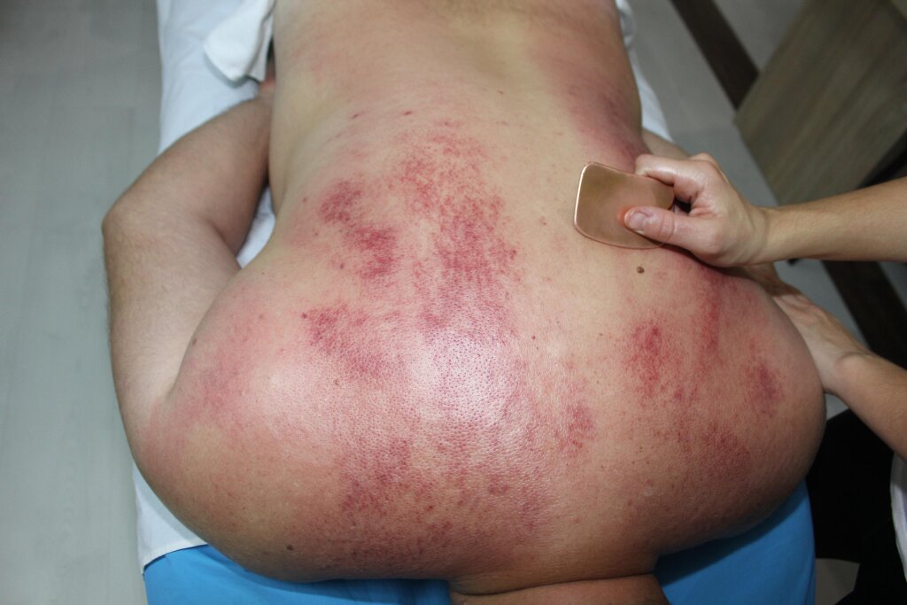 Masaj Gua Sha (General) - imaginea 6