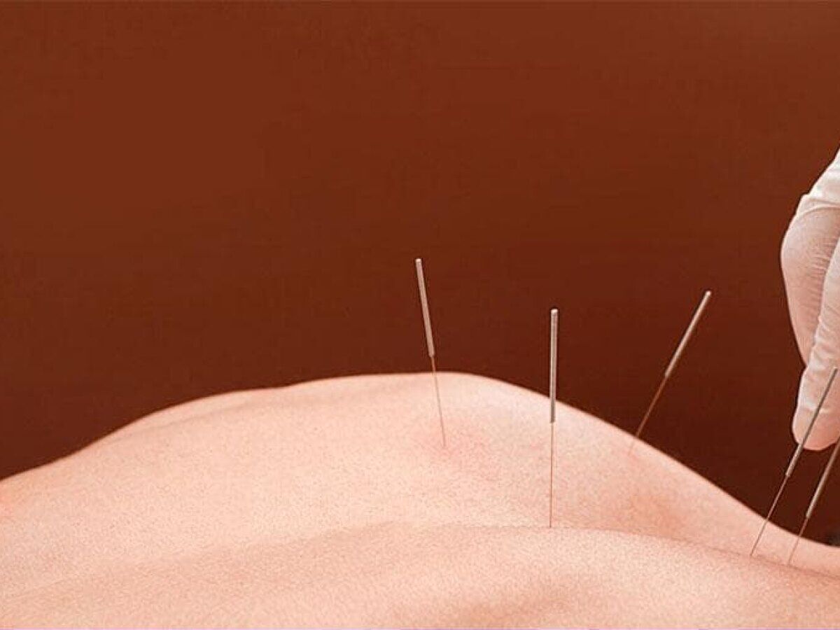 Acupunctura